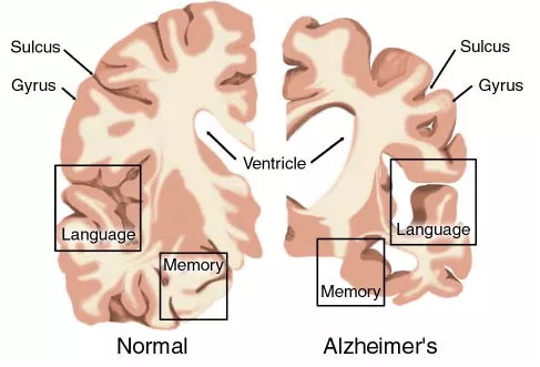 AD药物研发现状：辉瑞、礼来、百健、诺华、强生……