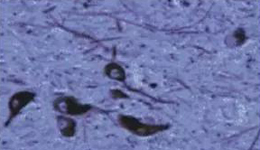 正常人：黑质神经元存在