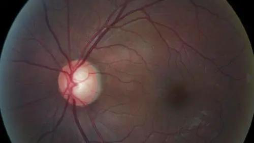 青光眼的克星来袭，助力患者远离视力的“窃贼”