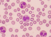 一种神秘颗粒被发现了！它能否成为败血症早筛标志物？